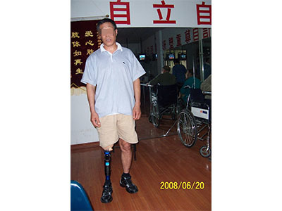 青島市遠征假肢矯形器 專業(yè)假肢與矯形器的選擇與服務(wù)